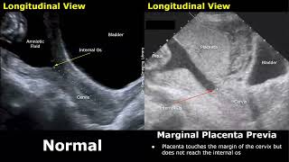 Obstetric Ultrasound Normal Pregnancy Vs Placenta Previa  LowLying Marginal Partial Complete [upl. by Drawe]