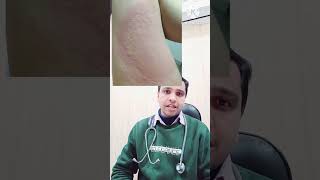 पित्ती उछलना urticaria Homeopathic treatment shorts [upl. by Aschim]