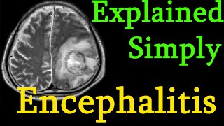 Encephalitis  brain inflammation  Symptoms causes prognosis Treatment explained simply [upl. by Ailaham]