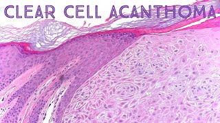 Clear Cell Acanthoma Dermpath in 5 Minutes pathology dermatology dermatopathology [upl. by Wit]