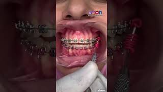 ¡🔥CITA 📅 de mantenimiento de los brackets 😬🔥 [upl. by Mathian]