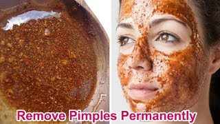 पिम्पल्स को जड़ से खत्म करने के असरदार घरेलू उपाए  How to get rid acne scars fast in 3 days [upl. by Tnairb]