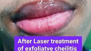 Two cases of exfoliatve cheilitis treated by Laser excellent response [upl. by Nahem]