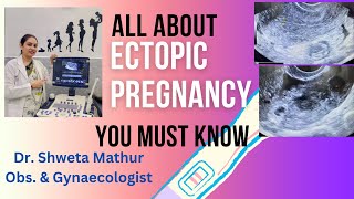 Pregnancy test positive Can it be Ectopic Learn Risk factors  symptoms  diagnosis amp treatment [upl. by Haramat]