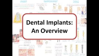 Implants An Overview Osseointegration Types of Bone One stage vs Two stage surgery [upl. by Erlewine]