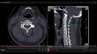 nect ct anatomy aryepiglottic foldscobra fangs analogy [upl. by Llewej]