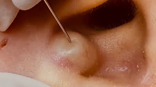 NEW Large Cyst Removal BEST POPS Compilation  w relaxing music amp an OOZ GALORE [upl. by Arikahs]