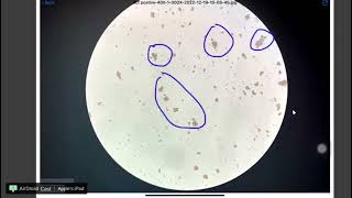 Direct coombs test positive test under microscope [upl. by Cobb]