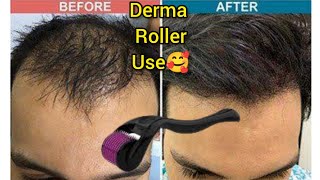 How Many Times Derma Roller can be used  Derma Roller Hair Regrowth  Microneedle At Home [upl. by Aisinoid]