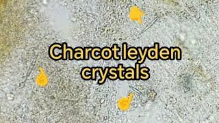 Charcot leyden crystals in Stool، Giardia lambelia trophكريستالات الجاركوت لايدين Stool examination [upl. by Eiclehc743]