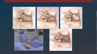 Radiología Intervencionista de la Columna Vertebral [upl. by Dulcy222]