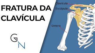 FRATURA DA CLAVÍCULA Preciso de cirurgia [upl. by Lahcym147]