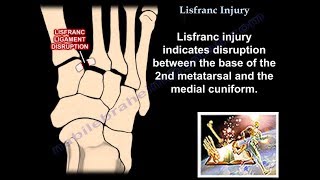 Lisfranc Injury  Everything You Need To Know  Dr Nabil Ebraheim [upl. by Corneille]