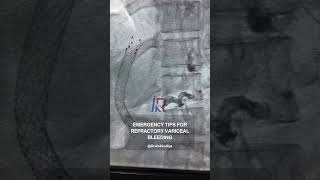 Emergency TIPS for refractory variceal bleeding TIPS dralokkudiya VaricealBleeding [upl. by Poirer]