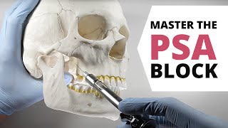 HOW TO DO A POSTERIOR SUPERIOR ALVEOLAR PSA NERVE BLOCK  OnlineExodontiacom [upl. by Sirama]