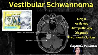 242Vestibular Schwannoma  Acoustic neuroma surgeryeducation [upl. by Anaujnas]