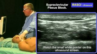 Ultrasound guided Supraclavicular plexus block [upl. by Annaicul]