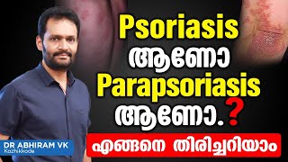 Psoriasis ആണോ Parapsoriasis ആണോഎങ്ങനെ തിരിച്ചറിയാം  Psoriasis Malayalam Treatment  Dr Ahiram VK [upl. by Nelleoj400]