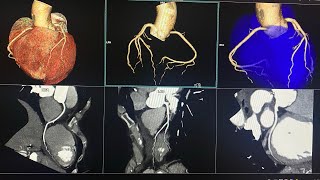 CTA CORONARY  Siemens 128 Somatom goTop  65 ml Contrast flow rate 55 mls HMS MIRDIF HOSPITAL [upl. by Adnilasor]