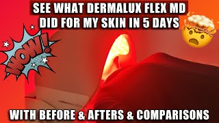 SEE WHAT DERMALUX FLEX MD DID FOR MY SKIN IN 5 DAYS  W BEFORE amp AFTERS DEMO amp COMPARISONS [upl. by Anilecram599]