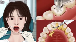 ASMR Dental Treatment Animation 🦷 Satistfying Tartar amp Caries Removal  Mengs Stop Motion [upl. by Yvad]