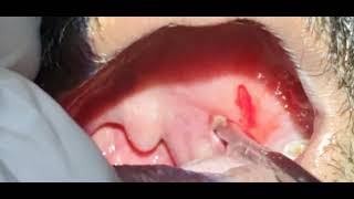 Peri tonsillar abscess Quinsy  Dr Hitesh Patel [upl. by Akinohs762]