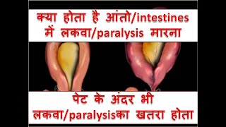 what is INTESTINAL PSEUDO  OBSTRUCTIONPARALYTIC ILEUSOGILVIE SYNDROME [upl. by Bartolome]