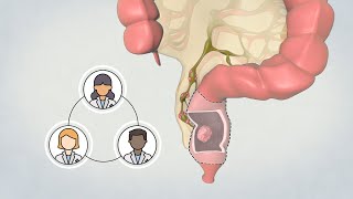 Patient Teaching Low Anterior Resection  Surgical Management of Rectal Cancer  TVASurg [upl. by Cini]