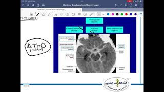 NS Medicine Subarachnoid Hemorrhage [upl. by Herzen412]