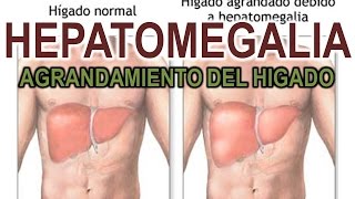 HEPATOMEGALIA  AGRANDAMIENTO DEL HIGADO [upl. by Earissed]