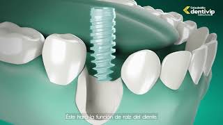 Implantes Dentales [upl. by Marrissa]