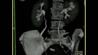 Abdomen Kidney Transitional cell carcinoma of the ureter [upl. by Lucais201]