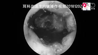 Severe cholesteatoma of the external auditory canal which has eroded the skeleton [upl. by Torras]