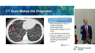 Overview of Bronchiectasis [upl. by Charin710]