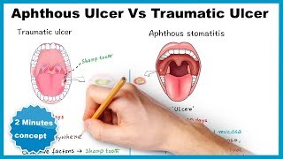 Aphthous ulcerstomatitis Vs Traumatic ulcer [upl. by Allit]