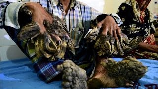 Bangladeshs Tree Man has surgery to remove warts [upl. by Ora]