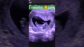 Level 2 ultrasound गर्भवती का महत्वपूर्ण अल्ट्रासाउंड [upl. by Modeste193]