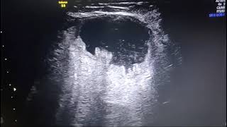 Ileal Conduit Ultrasound Picture [upl. by Alessandra]