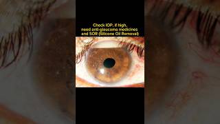 Inverse hypopyon retina clinical intresting eye [upl. by Erej356]