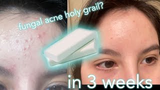 FOREHEAD ACNE BUMPS GONE FOREVER [upl. by Lipkin]