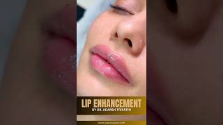 Amazing Plump Lips With Lip Fillers  Sarayu Clinics fillers [upl. by Rooney]