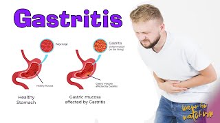 Gastritis  Causes  Signs and symptoms  Foods to avoid gastritis [upl. by Bj422]