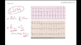 LVH on ECG Left ventricular hypertrophy  Learn ECG  Dr Jamal USMLE [upl. by Suoivatram371]