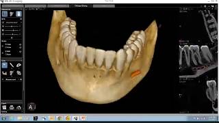 CS 3D Imaging Software Training CBCT Anatomical Review of the Mandible [upl. by Cathi684]