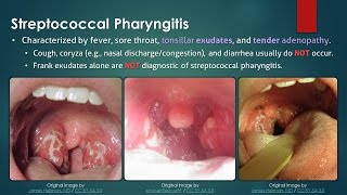 Streptococcal Pharyngitis [upl. by Ardnas]