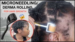 MICRONEEDLINGDERMA ROLLING FOR EDGE GROWTH  Two Month Update  TRACTION ALOPECIA 🚨 NO MINOXIDIL [upl. by Randie292]