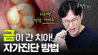 금이 간 치아 치아 균열증‼️ 방치하면 발치까지 할 수도 😱⎜치아크랙 자가진단방법과 치료방법까지 [upl. by Sualokin482]