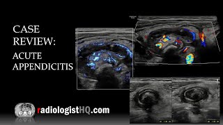 Ultrasound of Acute Appendicitis [upl. by Lagas]