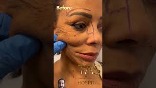 scarless facelift plasticcsurgeon [upl. by Marina]