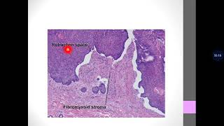 Basic Dermatopathology 17 Other epithelial tumors [upl. by Oruntha]